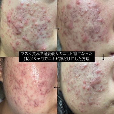 年代 肌質別 ティーツリーケア ソルーション エッセンシャルマスクex Medihealの口コミ 6件 Lips