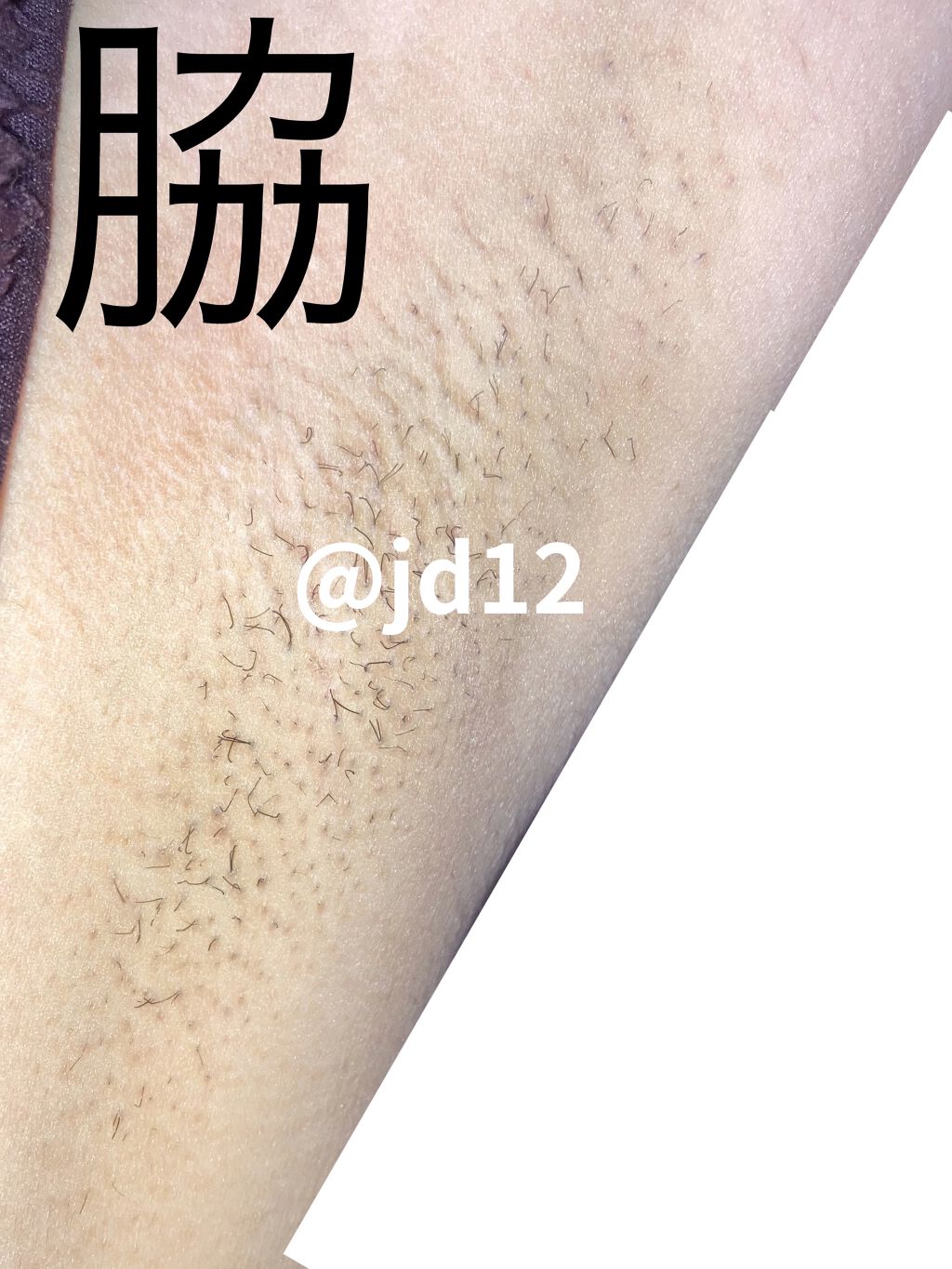 家庭用脱毛器 ケノン Ke Non エムテックの口コミ 私の公開フォルダにケノンのまとめがあるの By そろそろ大学生 乾燥肌 10代後半 Lips