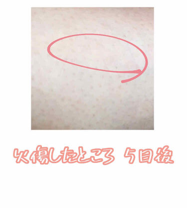 家庭用脱毛器 ケノン Ke Non エムテックの口コミ しまのケノン報告火傷した話 肌が赤く By しましまのしまうま 乾燥肌 10代後半 Lips