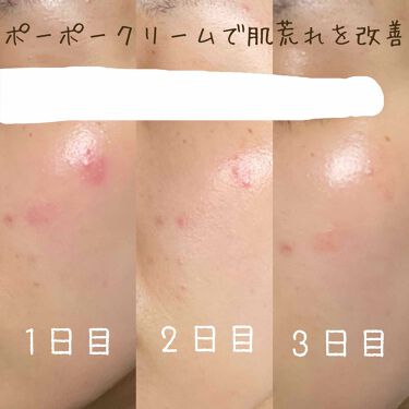 Lucas Papaw Ointment Lucas Papaw Remediesの効果に関する口コミ 化粧品が合わなかったのか マスクの肌荒れか By Ringo 敏感肌 Lips