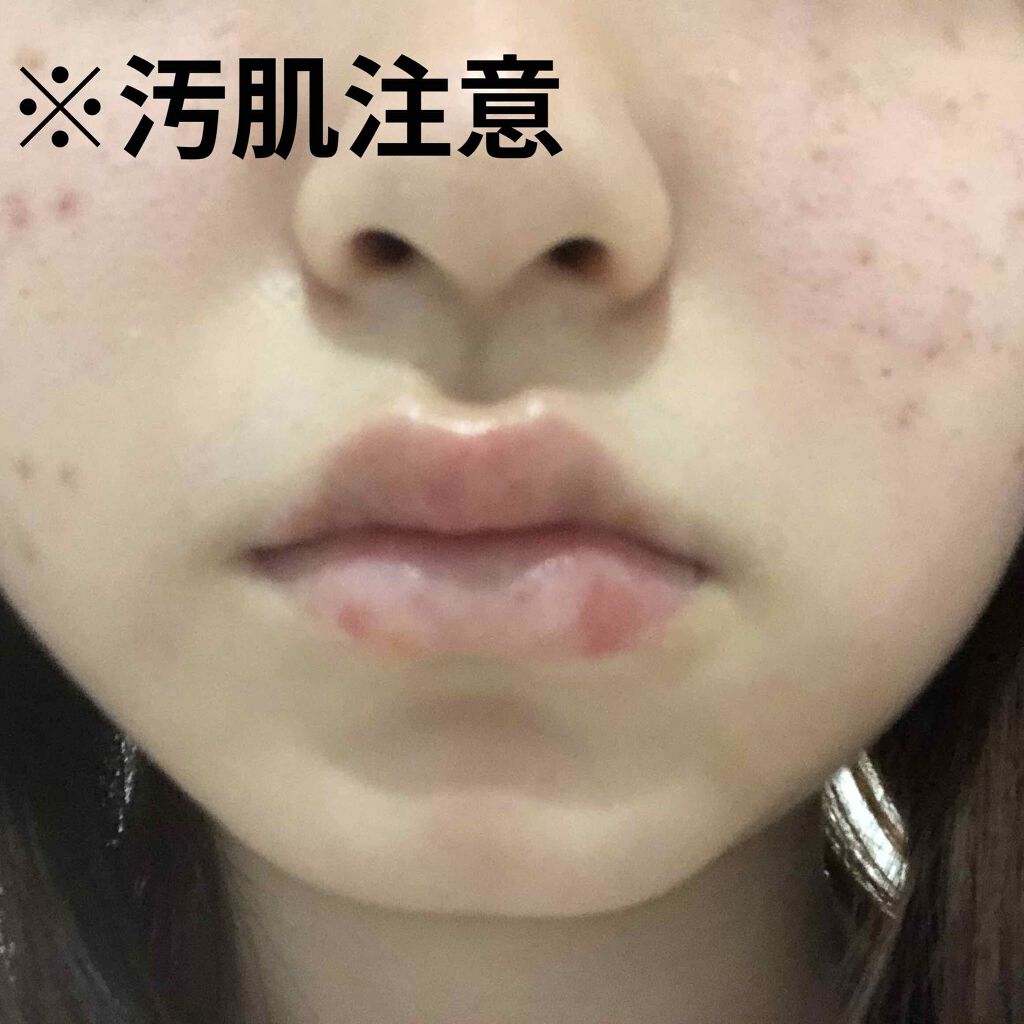 モアリップ N 医薬品 Shiseidoを使った口コミ 最近 突然口唇炎 口角炎になってしまいまし By まる 混合肌 Lips