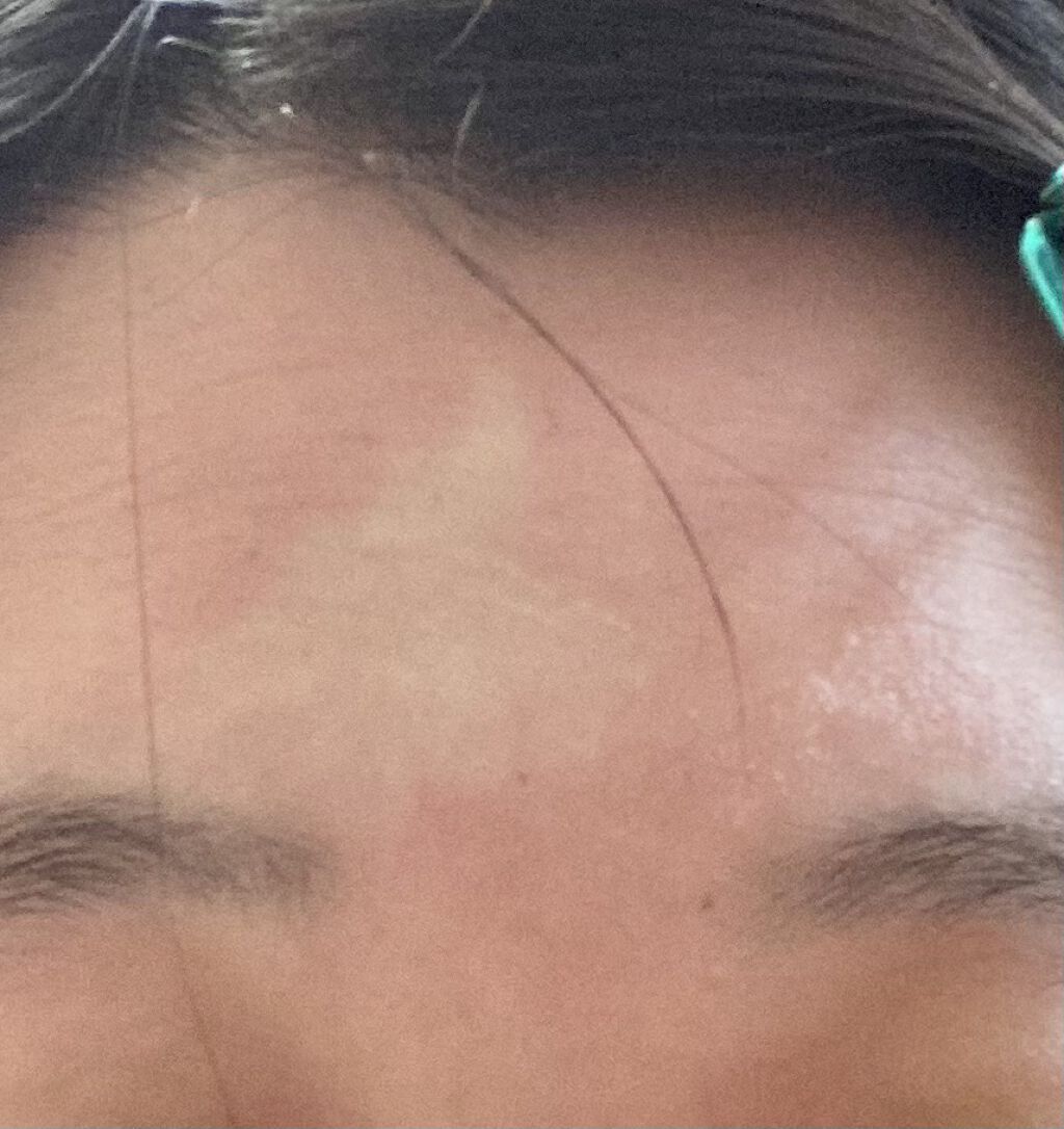 スキンケア方法 A アクネフォーム Novの使い方 効果 アトピー性皮膚炎で悩む By みるくもち アトピー肌 10代後半 Lips スキンケア方法 A アクネフォーム Novの使い方 効果 アトピー性皮膚炎で悩む By みるくもち アトピー肌 10代後半 Lips