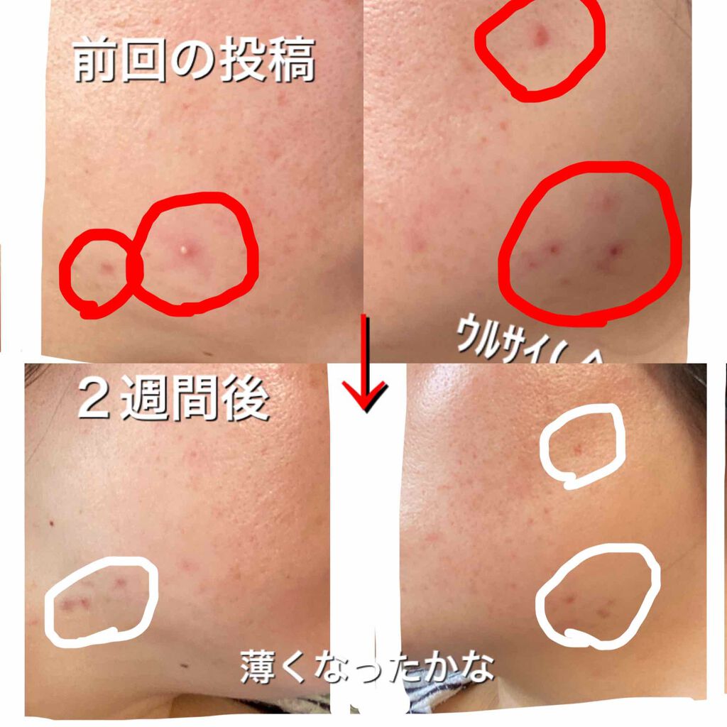 薬用しみ対策 美白化粧水 メンソレータム メラノccを使った口コミ こんにちは 絶賛コロナ太り真っ只中の主婦で By Amin 敏感肌 30代前半 Lips