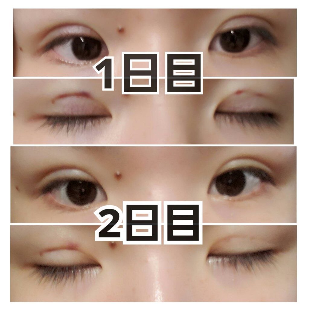 二重整形の口コミ 皆様こんにちは える です 今日は 二 By える 代前半 Lips