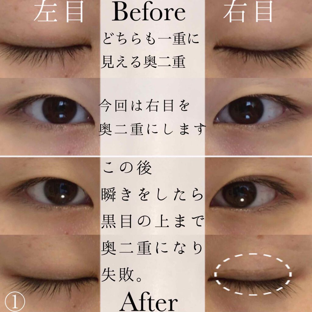 フリーファイバー メザイクの使い方を徹底解説 閲覧注意 目の画像が5枚目からあるので苦 By Rinayo 投稿休止中 混合肌 20代前半 Lips