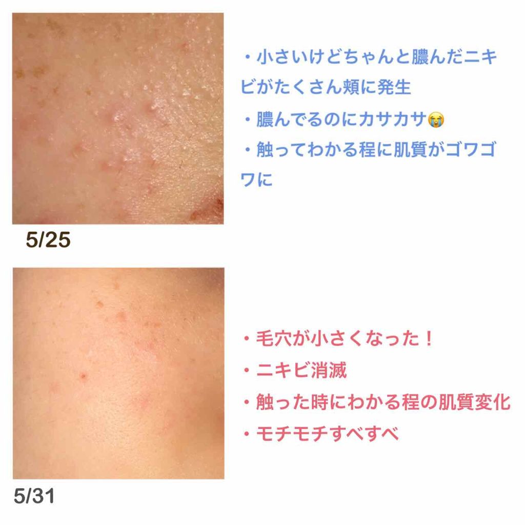 ビタミンc ハードカプセル Dhcを使った口コミ こんばんは テストから解放されたのでつい By ミルハ 混合肌 10代後半 Lips