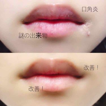 モアリップ N 医薬品 Shiseidoの口コミ 口角炎が1ヶ月ほど治らなくて皮は剥けるわフ By 撫子 混合肌 代前半 Lips