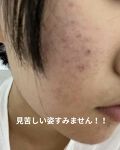 白色ワセリン 医薬品 健栄製薬の口コミ ニキビ肌をここまで治したドラッグストアで By Lさん 敏感肌 代前半 Lips