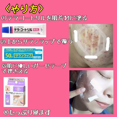 テラ コートリル 軟膏 医薬品 ジョンソン エンド ジョンソンの口コミ 私が最もニキビがひどかったときのお話 よく By ほたて 混合肌 代前半 Lips