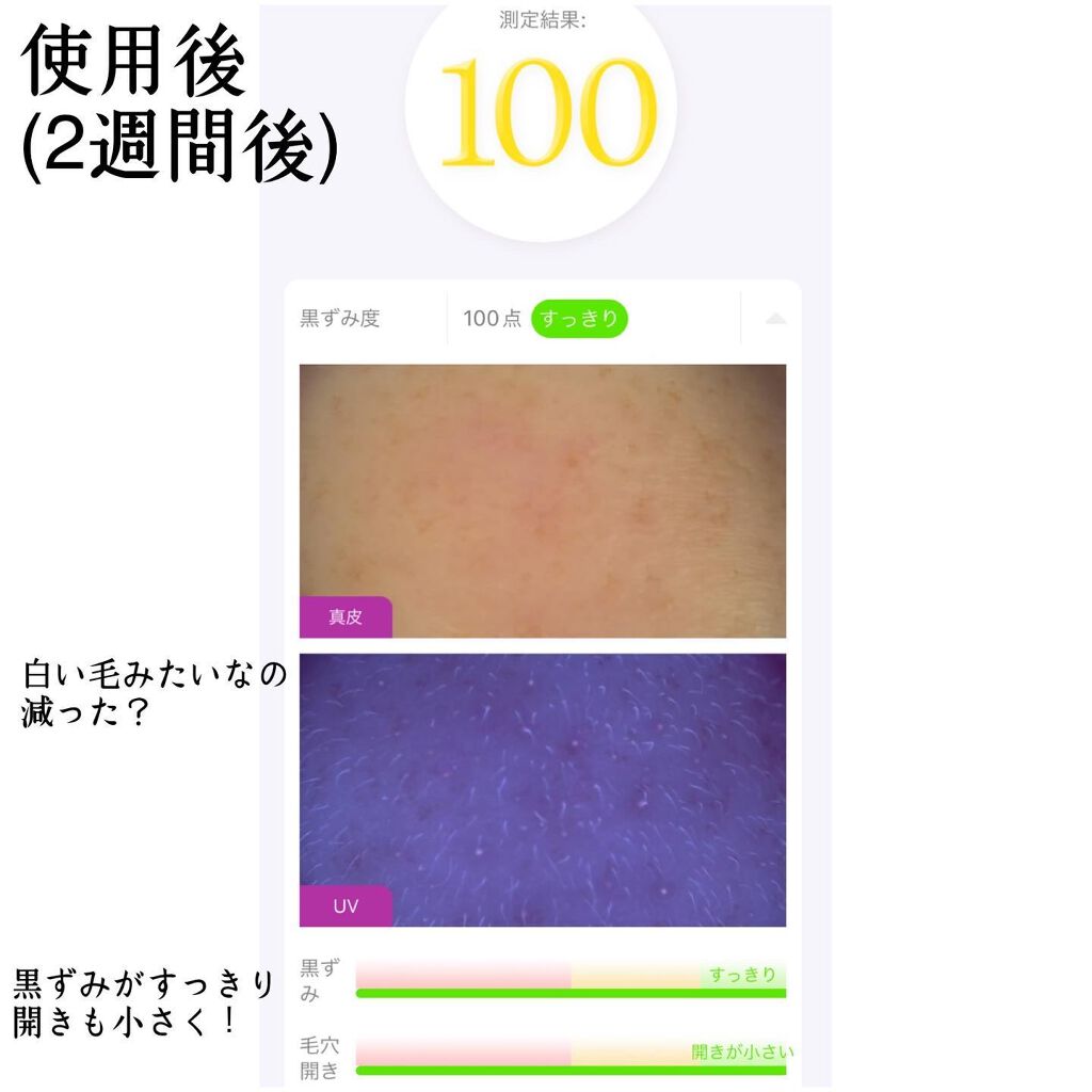 Medicube Zero Pore Pad 2 0 Medicubeを使った口コミ 本当に毛穴が綺麗になった 鼻の毛穴改善 2 By M 乾燥肌 代後半 Lips