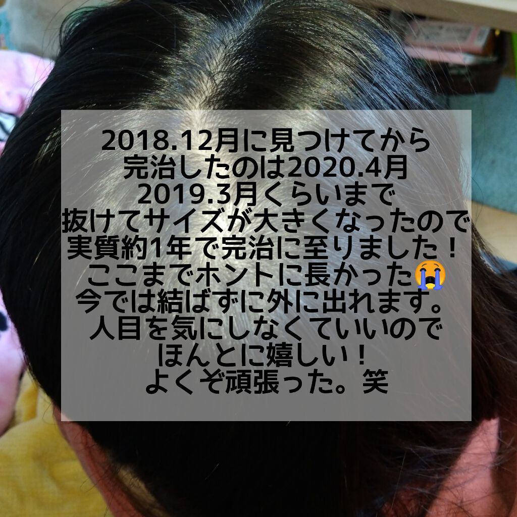 黒髪スカルプ プロ Haruを使った口コミ 最近 以前投稿していた 円形脱毛症にな By ｲﾅｶﾓﾝ 敏感肌 代前半 Lips