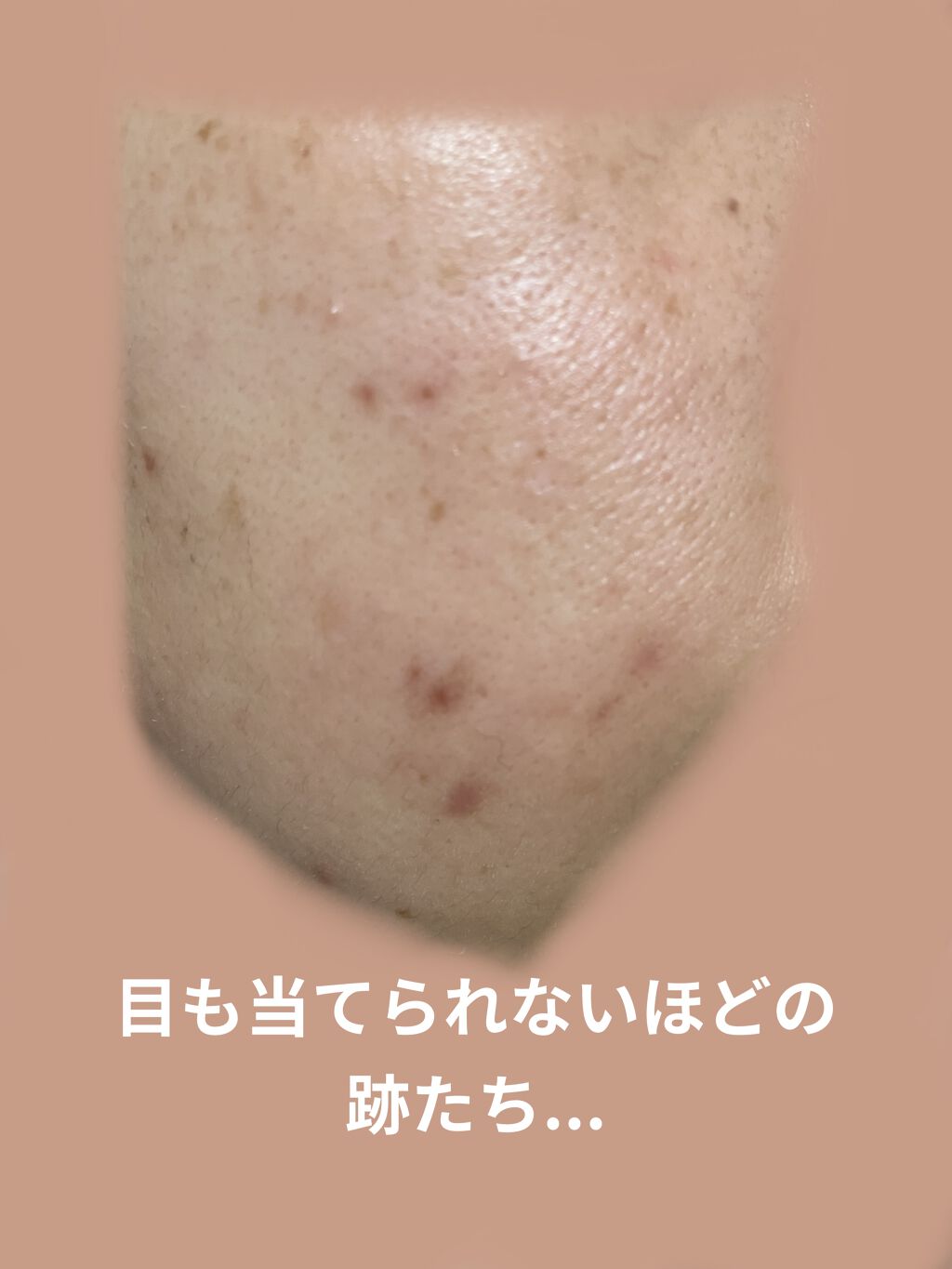 ニキビあとケアジェル アットノンの効果に関する口コミ 最近ずーっと肌荒れのことばっかりだったし By くるみ 混合肌 Lips