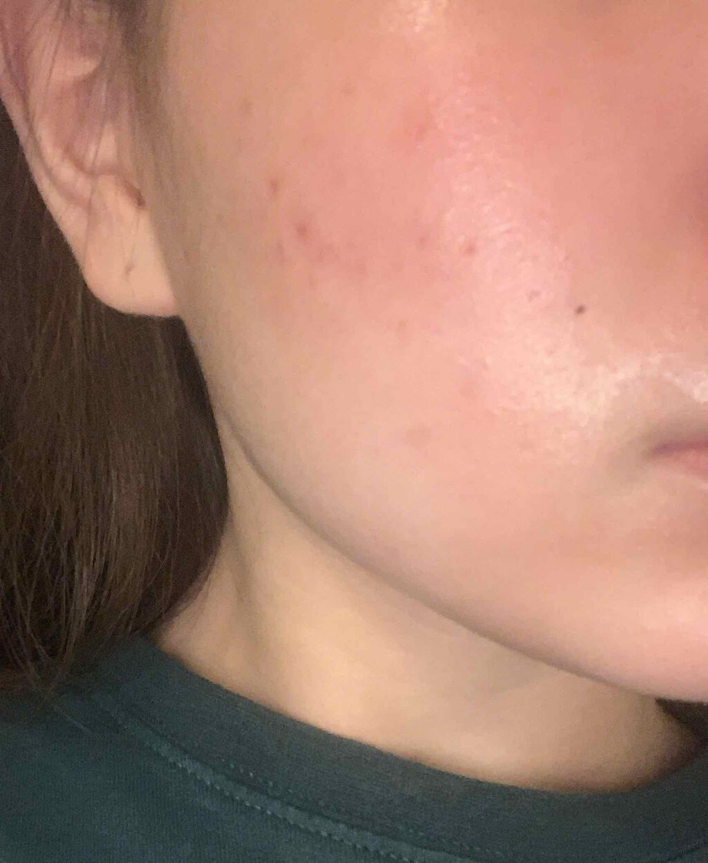 ロゼット洗顔パスタ アクネクリア ロゼットを使った口コミ こんばんは 今回は肌について語っていきます By こーちゃ 10代後半 Lips