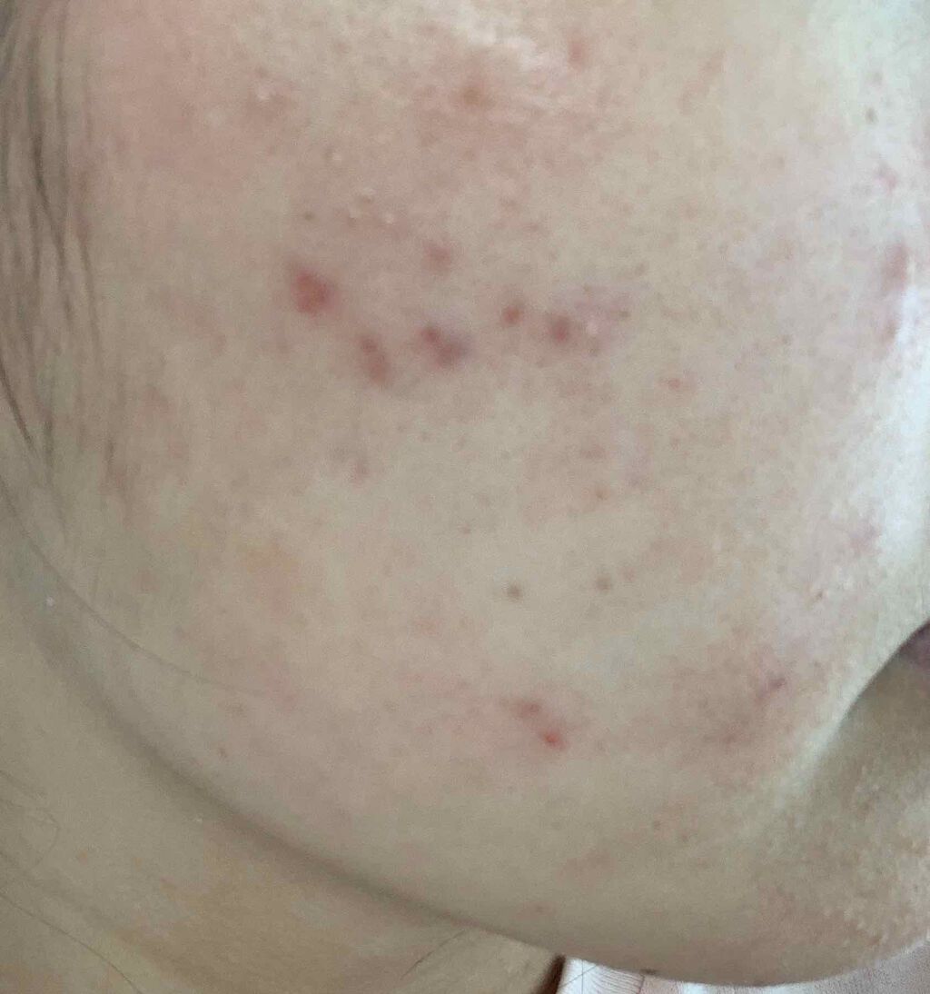 アミノモイスト 薬用アクネケア ローション ミノンを使った口コミ 最近ニキビの場所が赤くて痒い症状がでていま By みんぐぅ 混合肌 代前半 Lips