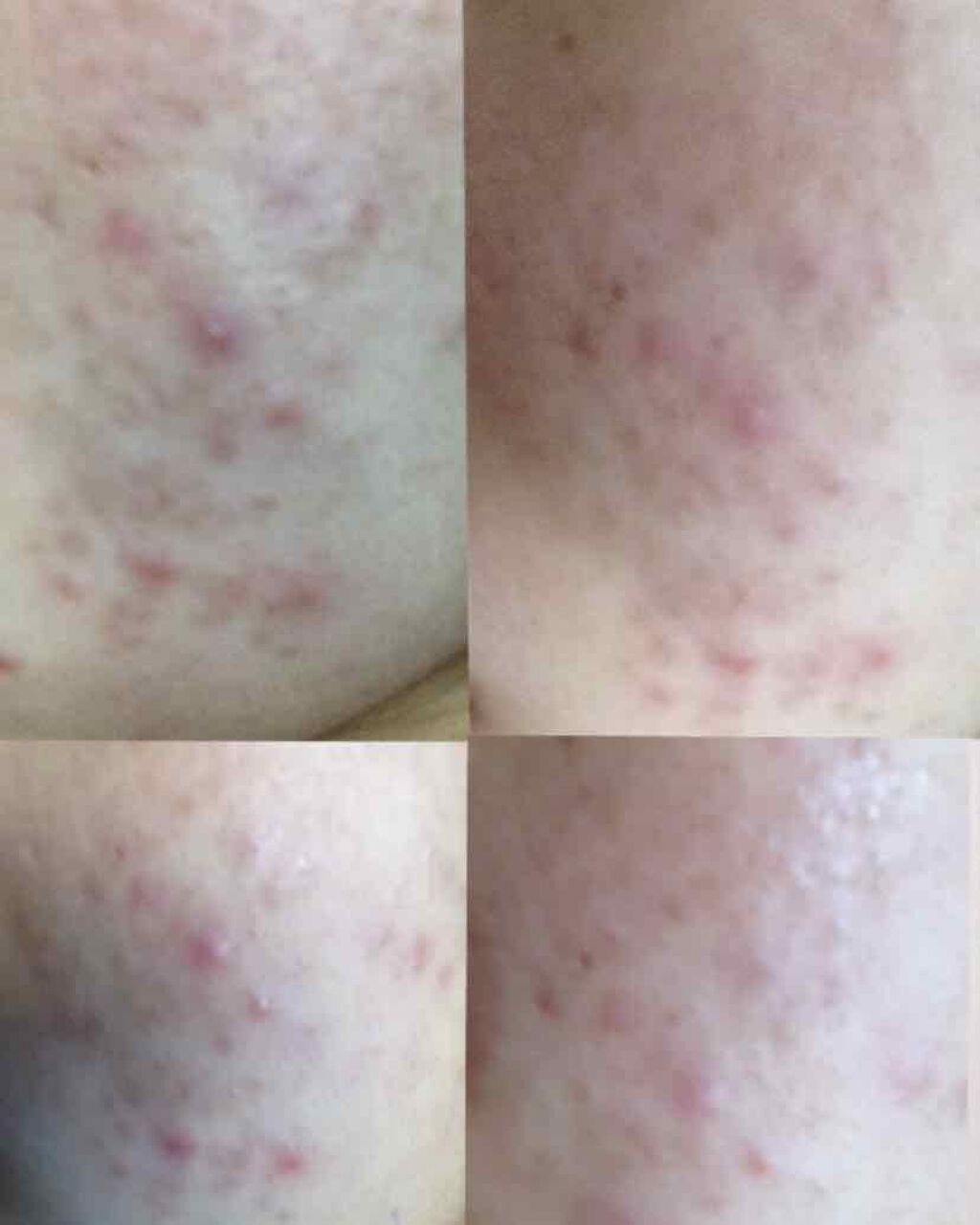 ディフェリンゲル0 1 医薬品 の口コミ 私の肌荒れ記録 閲覧注意 こんにちは By Supreme Lips 8sa 混合肌 Lips