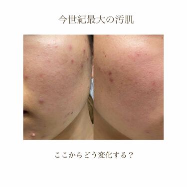 ベピオゲル 医薬品 を使った口コミ わたしのニキビ ニキビ跡ケア こんに By くまちょこ 乾燥肌 代前半 Lips