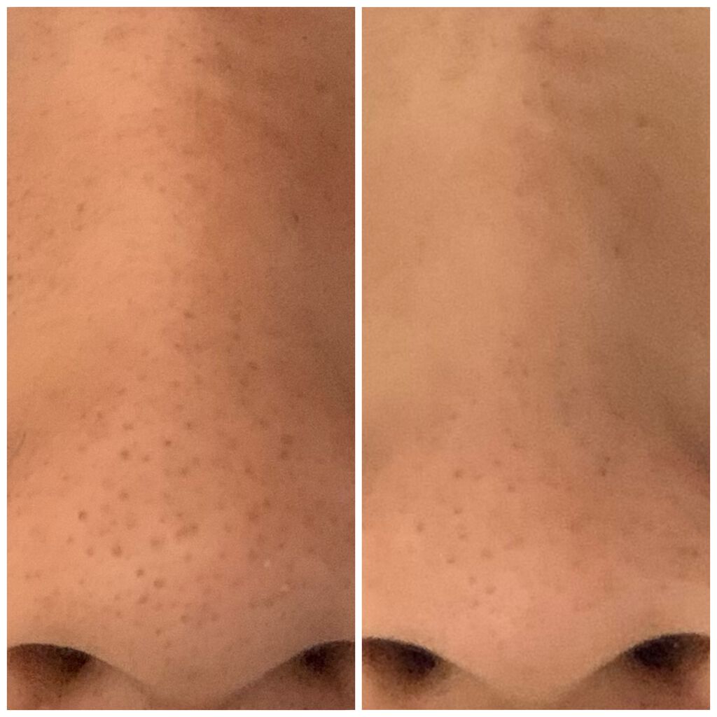 お米のパック 毛穴撫子の口コミ 汚い肌失礼します 毛穴撫子の By 여우 脂性肌 Lips