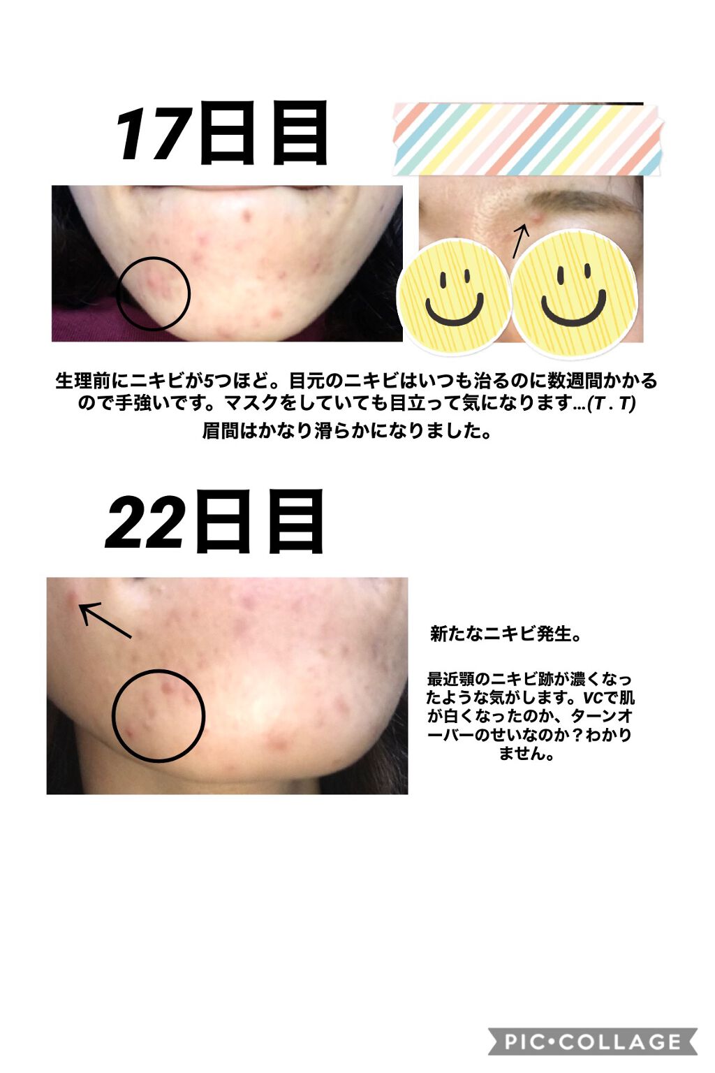 スキンケア方法 エピデュオゲル 医薬品 の使い方 効果 今まで色々なスキンケア By Sky 混合肌 30代後半 Lips
