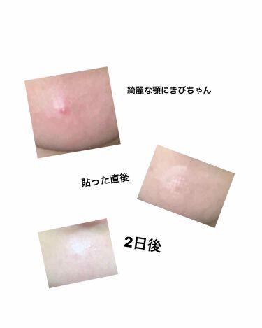 エイシーケア アクロパスの効果に関する口コミ １番おすすめのニキビパッチどんなに対策して By ぴぶちゃん 混合肌 代前半 Lips