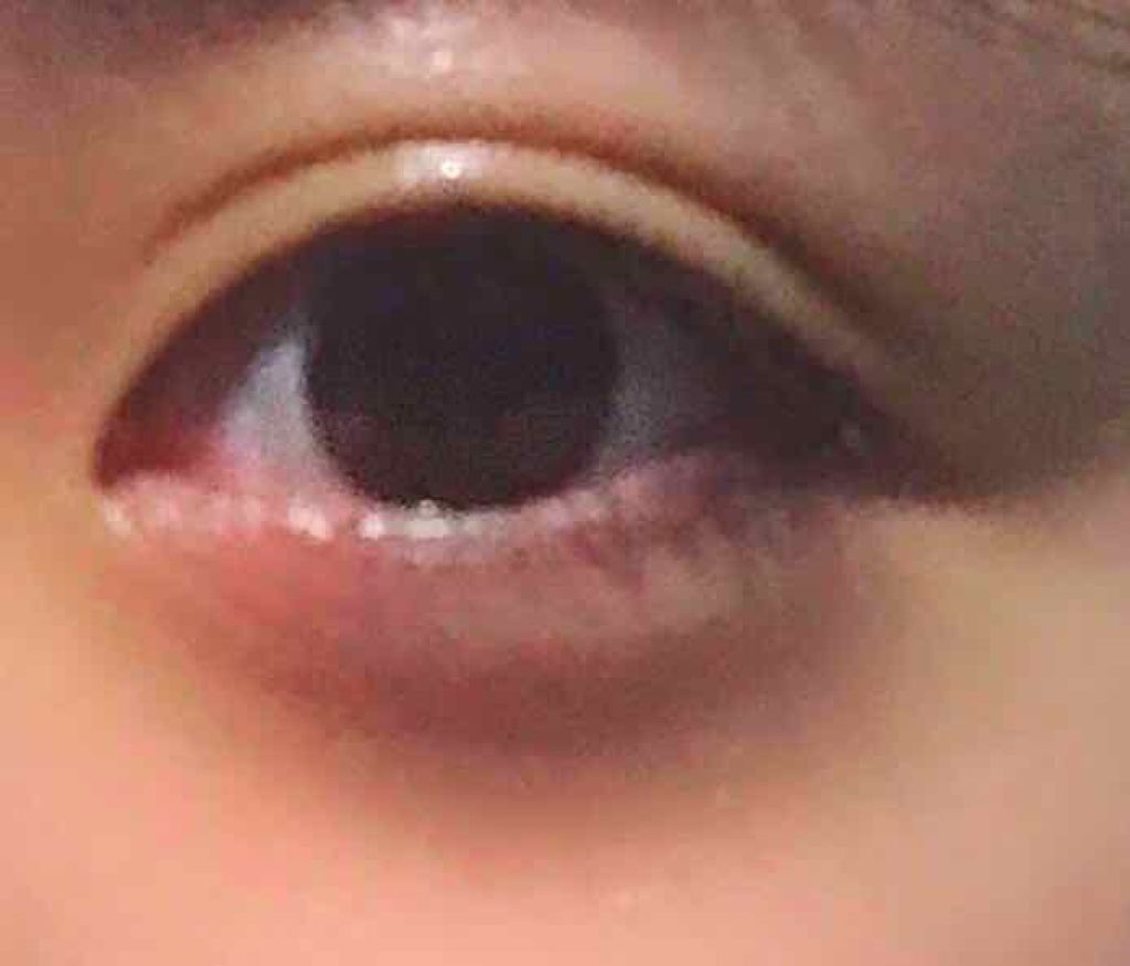 アイトーク 大人のまぶたコントロール アイトークの口コミ 普段は1枚目のようなすんとした一重です By 花子 Lips