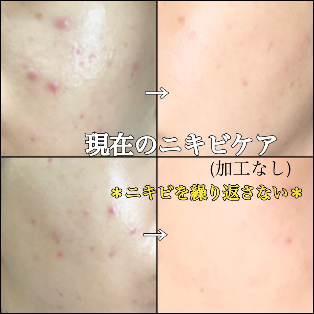 ベピオゲル 医薬品 を使った口コミ 久しぶりにニキビ関連載せます 過去にもニ By ゆゆ Lips