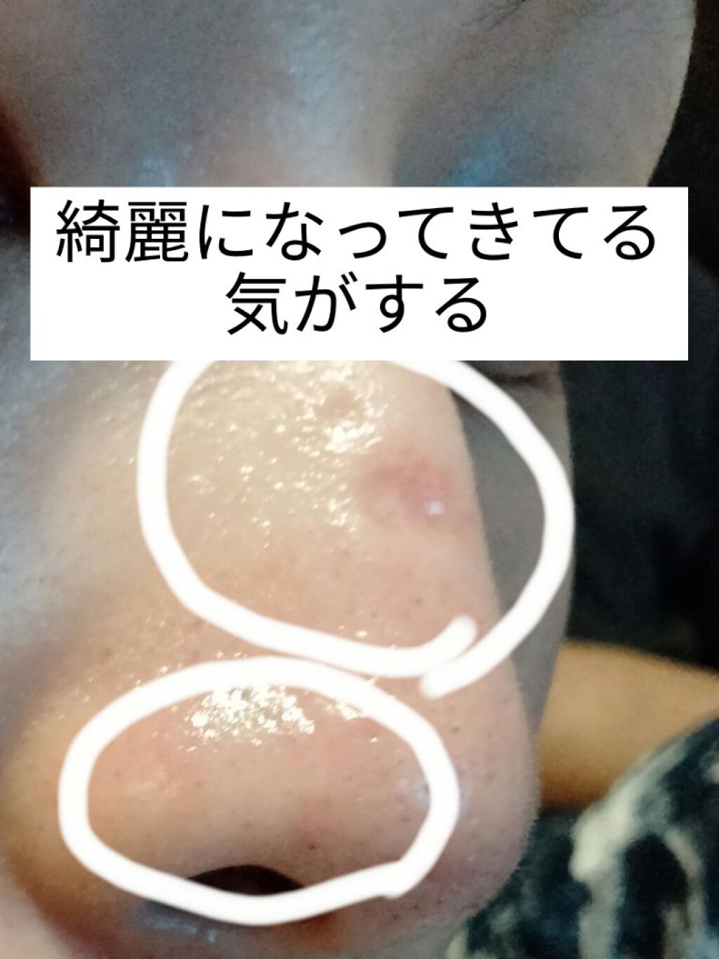 ダーマペン ダーマスタンプ Mymの口コミ こんにちは 愛ぱんです 今回はダーマペン7 By 愛ぱん 乾燥肌 30代後半 Lips