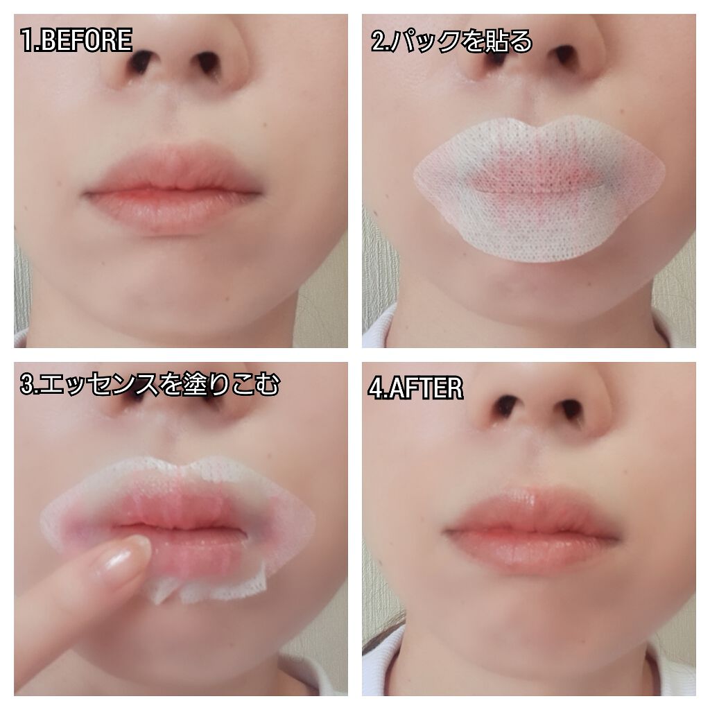 Lips Shot Motto Lab の口コミ 唇パックにマイクロニードル搭載 これは効 By さとち Satochi09 混合肌 Lips