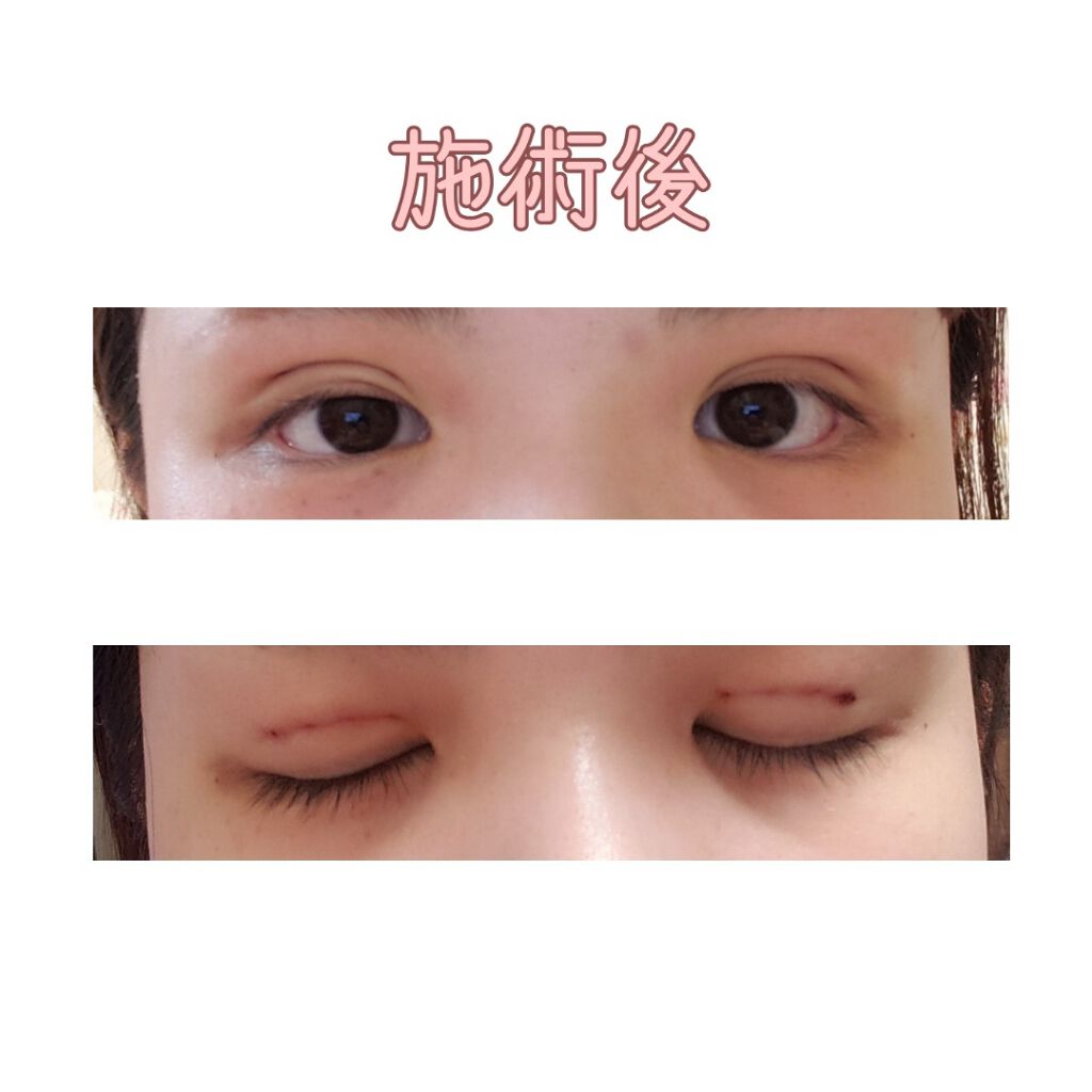 二重整形の口コミ この度 二重整形をしました 傷跡が苦手な方 By 𝕐𝕌 ℂℍ𝔸𝕄𝕌 敏感肌 Lips