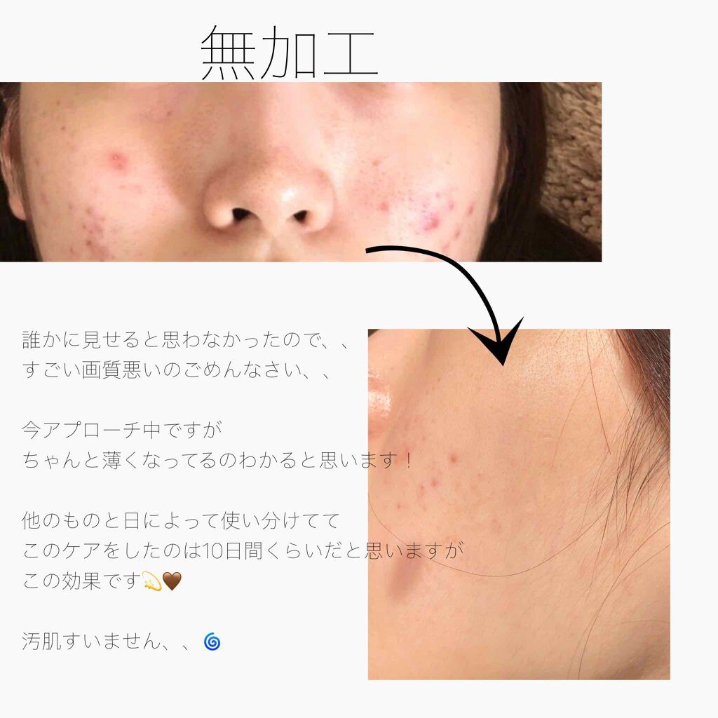 ミノン アミノモイスト 薬用アクネケア ローション ミノンを使った口コミ ニキビ ニキビ跡撲滅最強ケア 比較画像あ By 砂糖 代前半 Lips