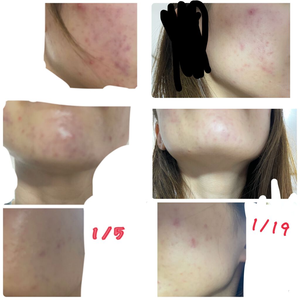 潤い濃密化粧水 ももぷりの口コミ もしかして少し良くなった フォトシルク By F 代前半 Lips