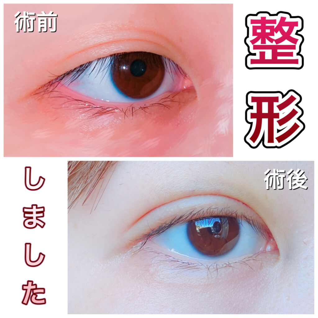 二重整形の画像 動画一覧 3ページ目 Lips