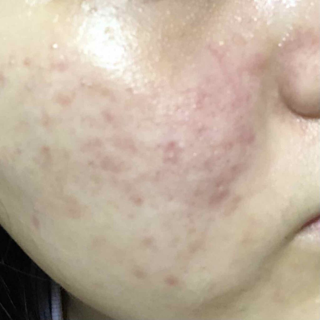 パワーマスク Sp ラッシュを使った口コミ 助けてください 2 3枚目閲覧 新し By わ アトピー肌 Lips