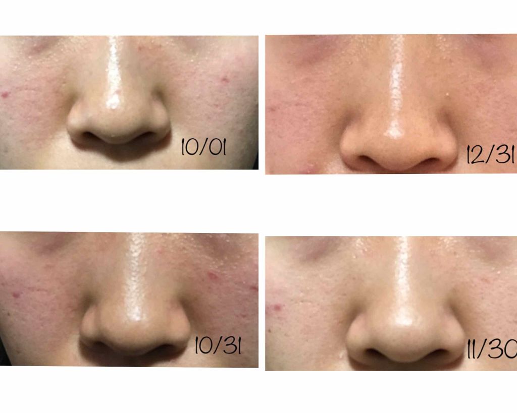 ウォッシャブル コールド クリーム ちふれを使った口コミ あけましておめでとうございます 3ヶ月間 By Nonane 乾燥肌 代前半 Lips