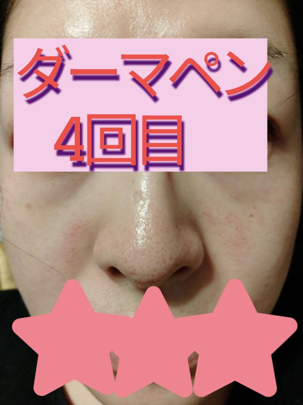 ダーマペン ダーマスタンプ Mymの口コミ こんにちは 愛ぱんです セルフダーマペン By 愛ぱん 乾燥肌 30代後半 Lips