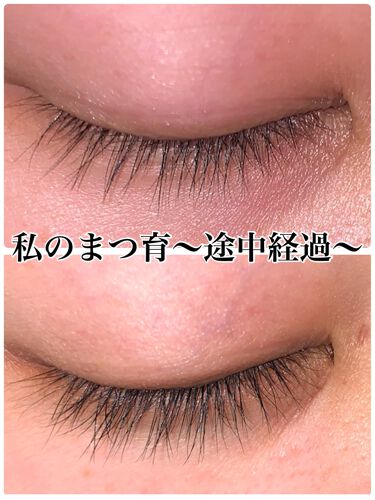 ケアプロスト サン ファーマシューティカルのリアルな口コミ レビュー Lips