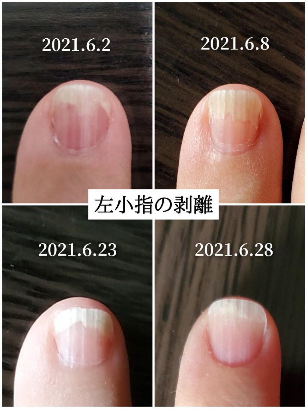 ネイルベッドオイル アンドネイルの口コミ 爪甲剥離症の育爪記録以前の投稿はこちらに By かぴめろん マイペース 乾燥肌 40代後半 Lips