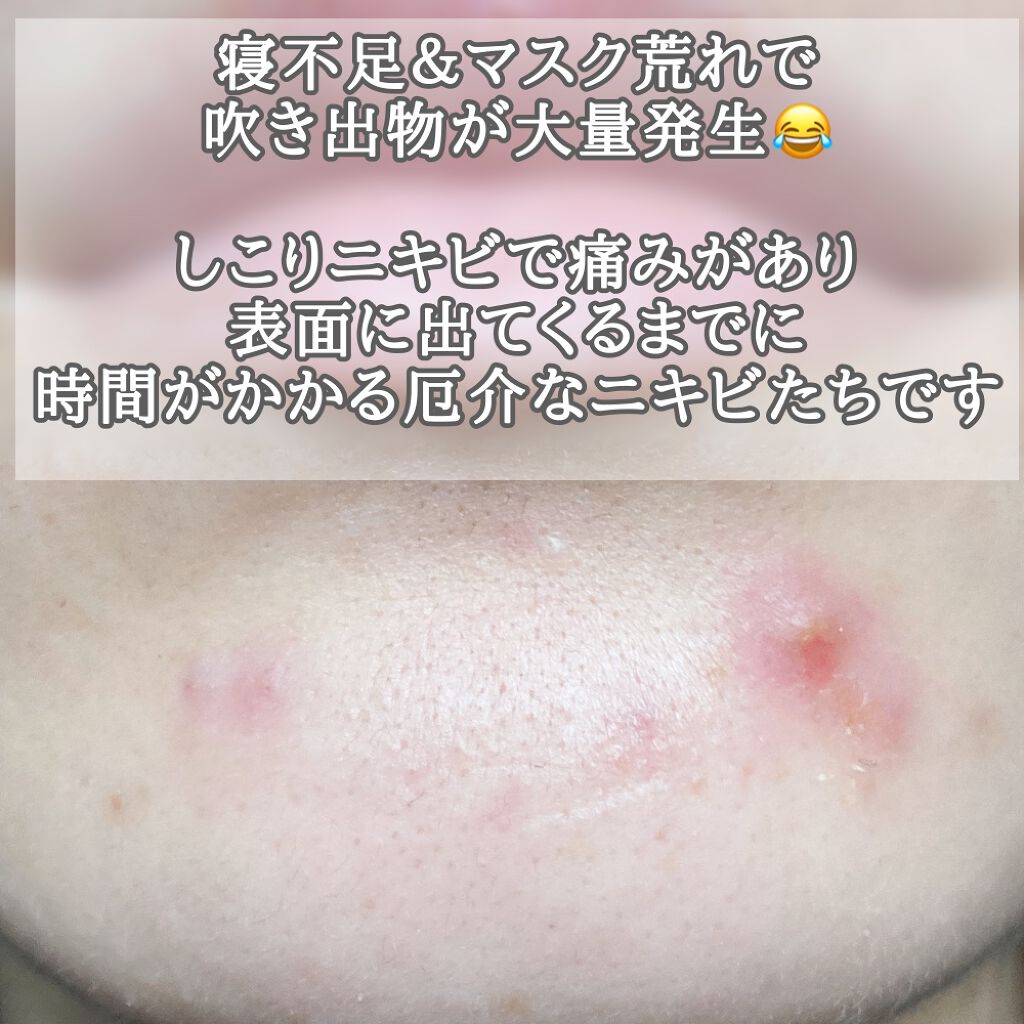 マキロン アクネージュ メディカルローション 医薬品 マキロンの口コミ やっぱニキビにはシカより医薬品マキロンアク By ブルベ夏みかん ˊ ˋ 敏感肌 代後半 Lips