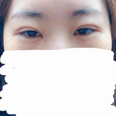 二重整形の口コミ 昨日sbcでフォーエバー二重術を受けてきま By さとう Lips