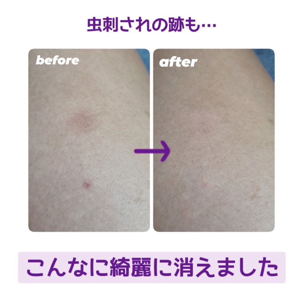 ストレッチコンシーラー Cezanneを使った口コミ 口角のくすみを綺麗に消す方法 使うものイ By 未設定 混合肌 Lips