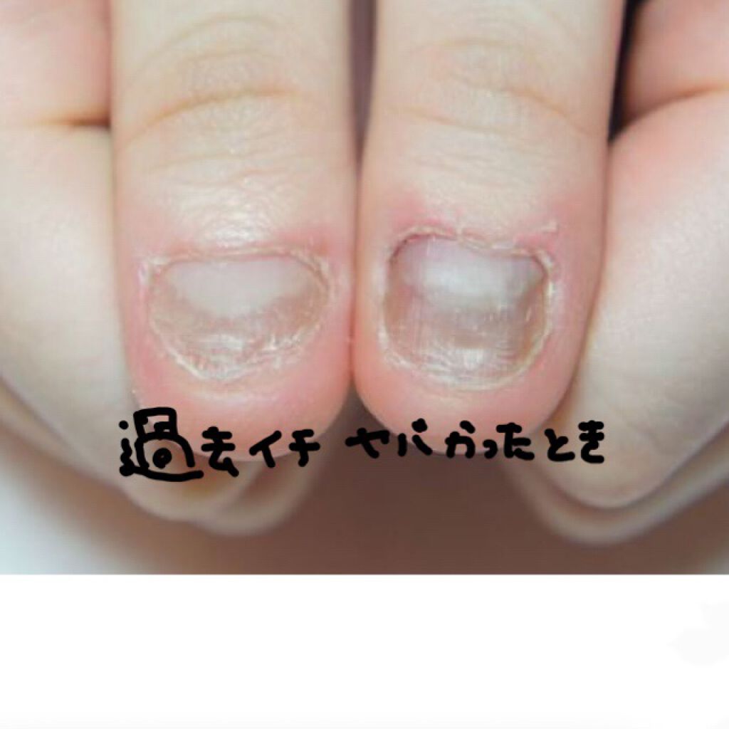 デイケアオイル Dr Nailの口コミ こんばんは 深爪ヤメ子です まだ2日目なの By 深爪ヤメ子 普通肌 代後半 Lips