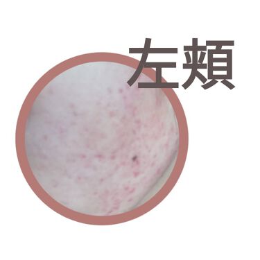 マルチビタミン 栄養機能食品 ビタミンb1 ビタミンc ビタミンe Dhcを使った口コミ 肌荒れとニキビに悩む高校生です 1日目 By ちーちょ 脂性肌 10代後半 Lips