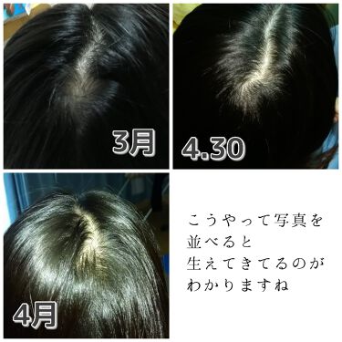 黒髪スカルプ プロ Haruを使った口コミ 最近 以前投稿していた 円形脱毛症にな By イナカモン 敏感肌 代前半 Lips 黒髪スカルプ プロ Haruを使った口コミ 最近 以前投稿していた 円形脱毛症にな By イナカモン 敏感肌 代前半 Lips