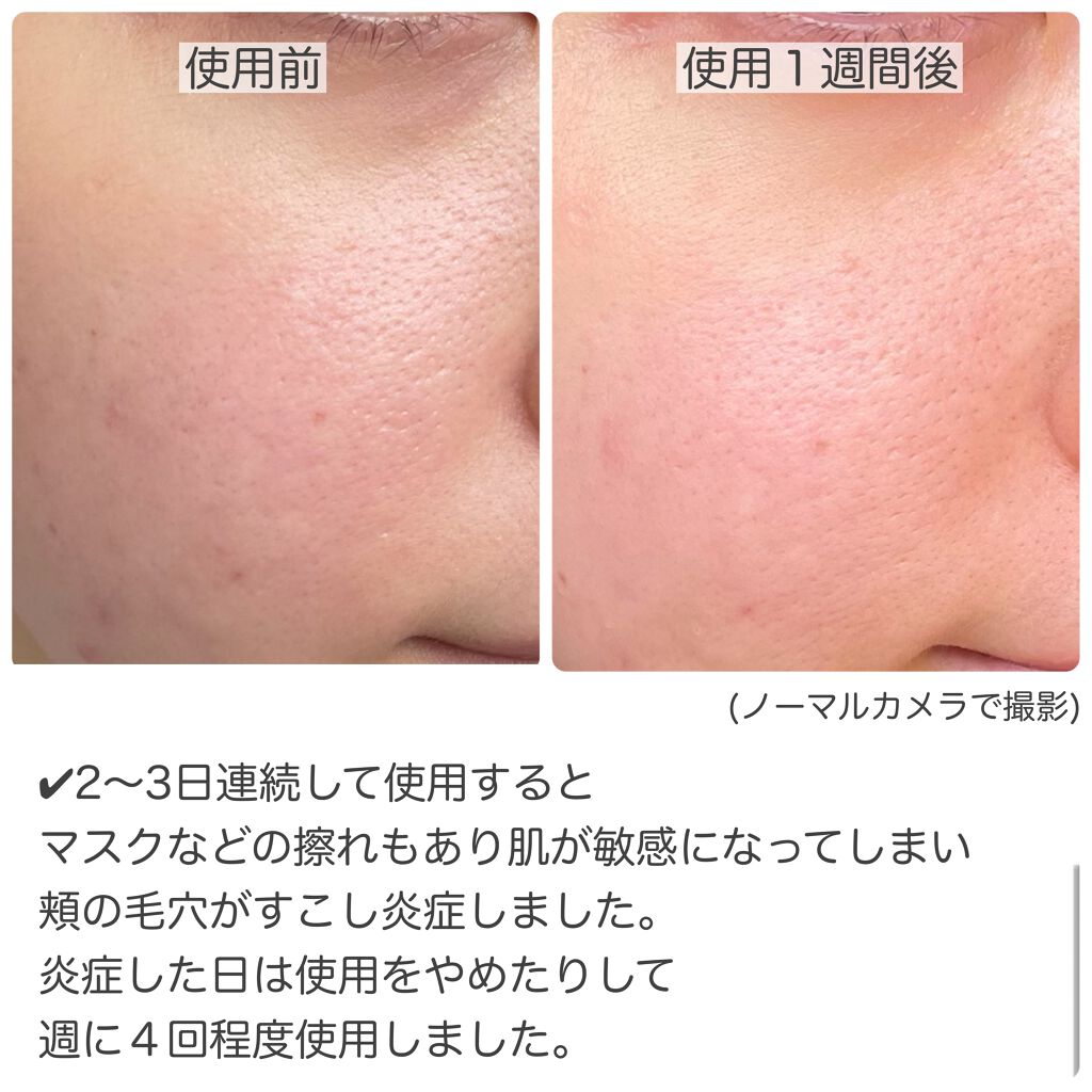 ザビタミンc23 Iopeの効果に関する口コミ 敏感肌におすすめの美容液 Iopeザビタ By けい フォロバ100 混合肌 20代後半 Lips