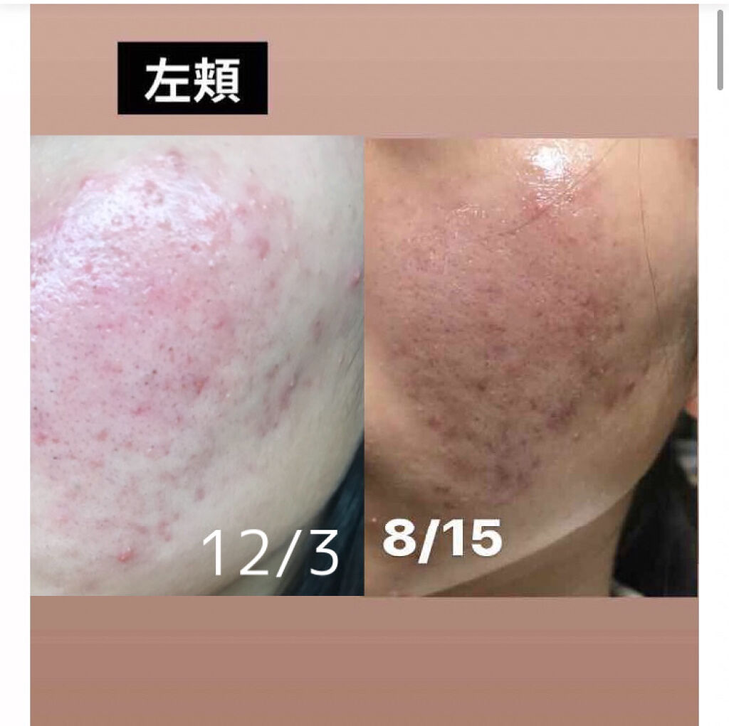 極潤ヒアルロン液 ハダラボモイスト化粧水d 肌ラボを使った口コミ ニキビ経過観察 光の当たり方で治ってるよ By ぽむ 混合肌 10代後半 Lips