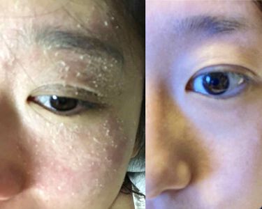 ミノン アミノモイスト モイストチャージ ミルク ミノンを使った口コミ ものすごく酷いアトピー肌が 頑張ってスキン By よっこ アトピー肌 代後半 Lips