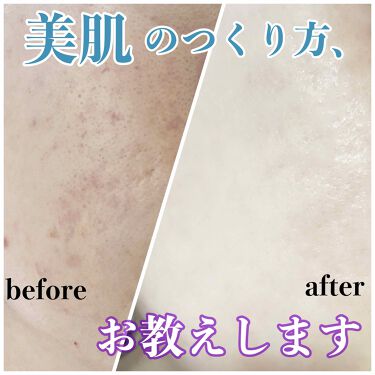 スキンコンディショナー高保湿 Cezanneを使った口コミ 3週間で変われます ひどいニキビ跡 赤み By もこもこ 普通肌 代後半 Lips