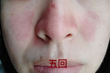 ダーマペン ダーマスタンプ Mymのリアルな口コミ レビュー Lips