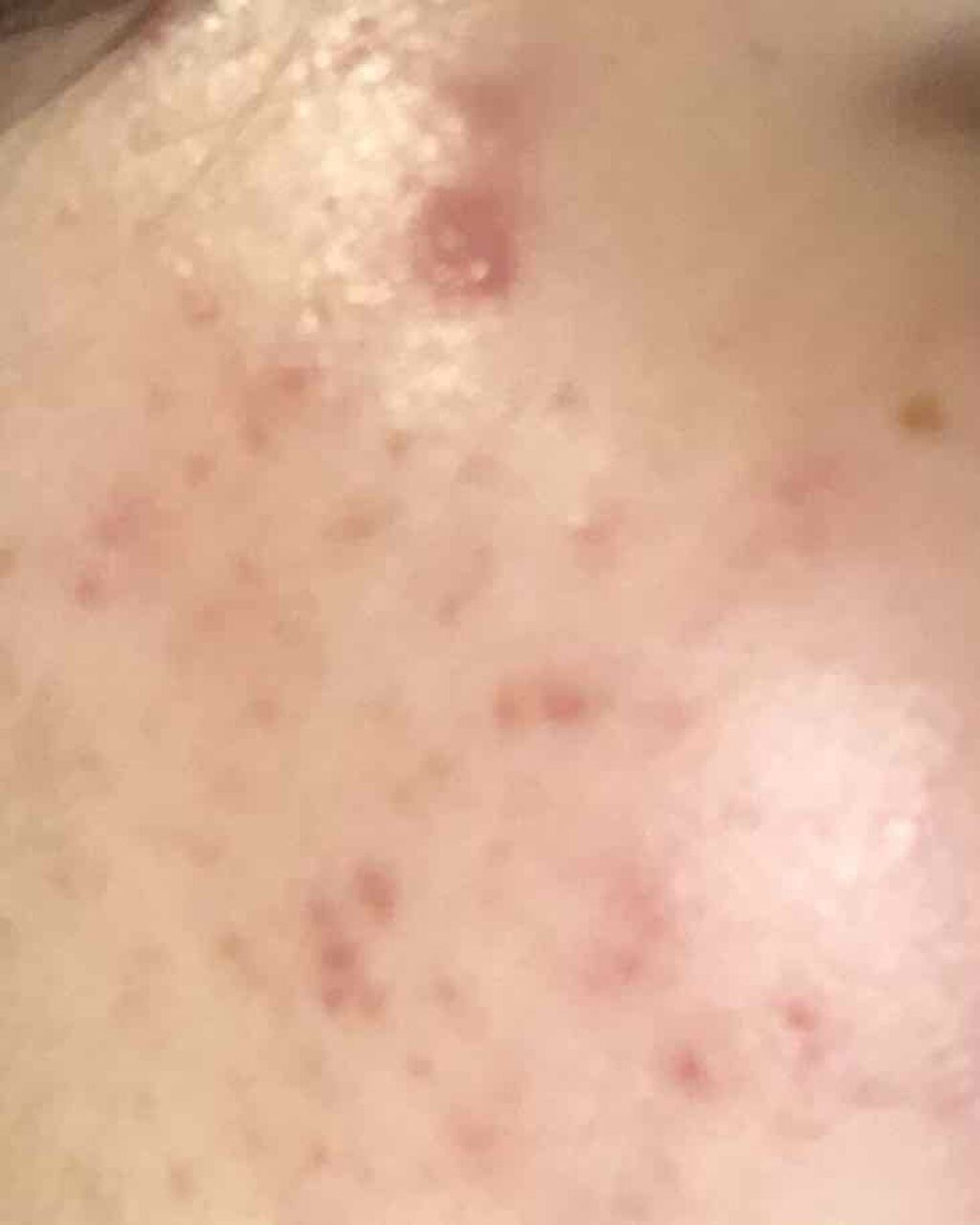 オロナインｈ軟膏 医薬品 オロナインを使った口コミ ニキビ生活vtcosmeticscicaス By さくらんぬ 脂性肌 Lips