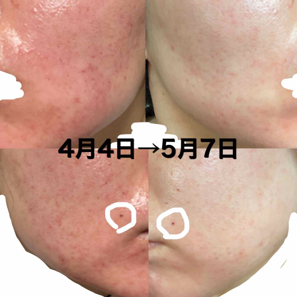 クナイプビオ オイル ローズ クナイプを使った口コミ こんにちは 5月1日のボディケア自己満宣言 By Amin 敏感肌 30代前半 Lips