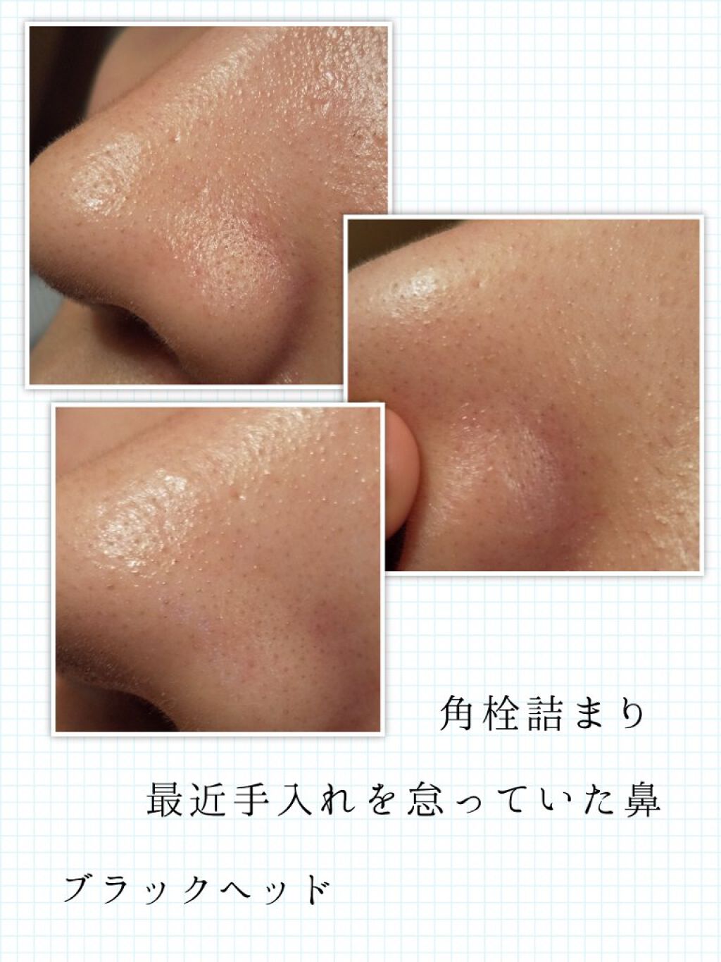 Pore Control Blackhead Off Sheet ビューティシート Ciracleを使った口コミ 30分で鼻の角栓を一掃 ウォーターピーリ By いももち 毛穴 混合肌 代前半 Lips